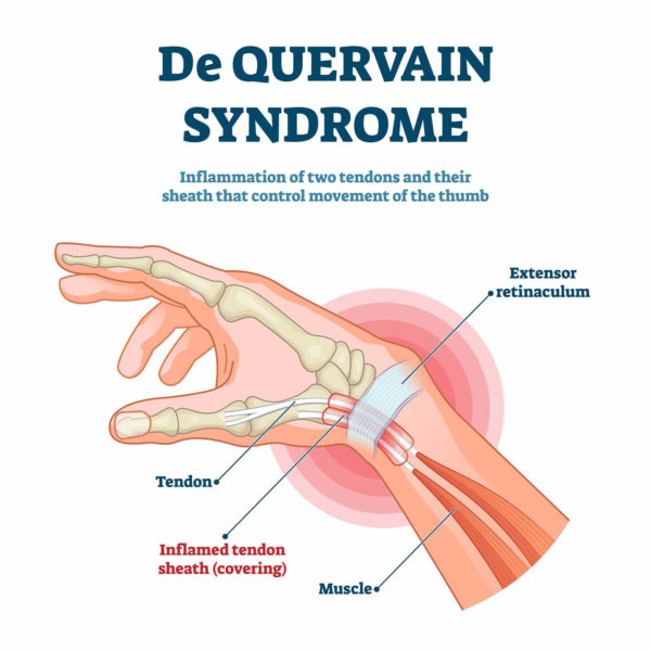 de quervain tenosynovitis steroid injection complications