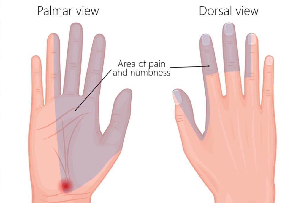 Carpal tunnel