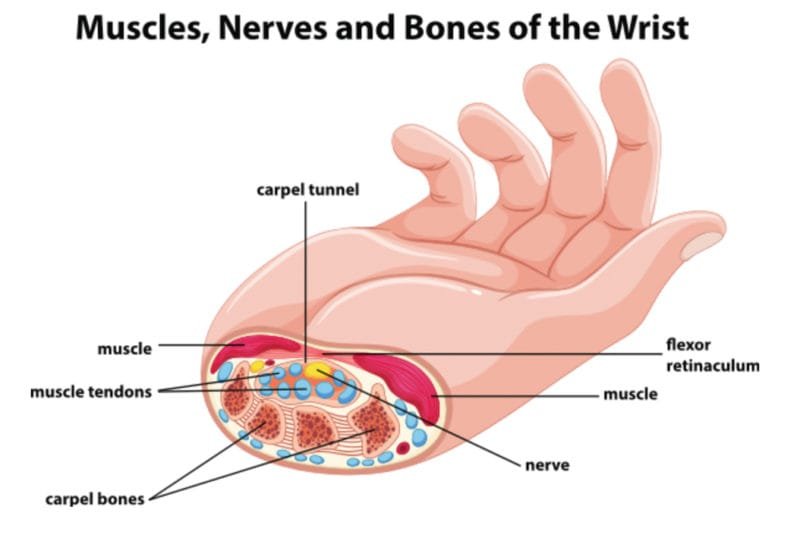 carpal tunnel