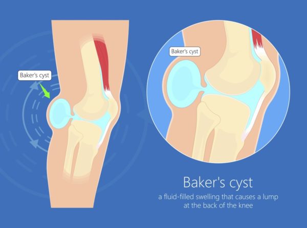 Baker's Cyst - A diagram of a Baker's Cyst