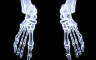 Morton's neuroma - human legs under X-rays. 3d image.