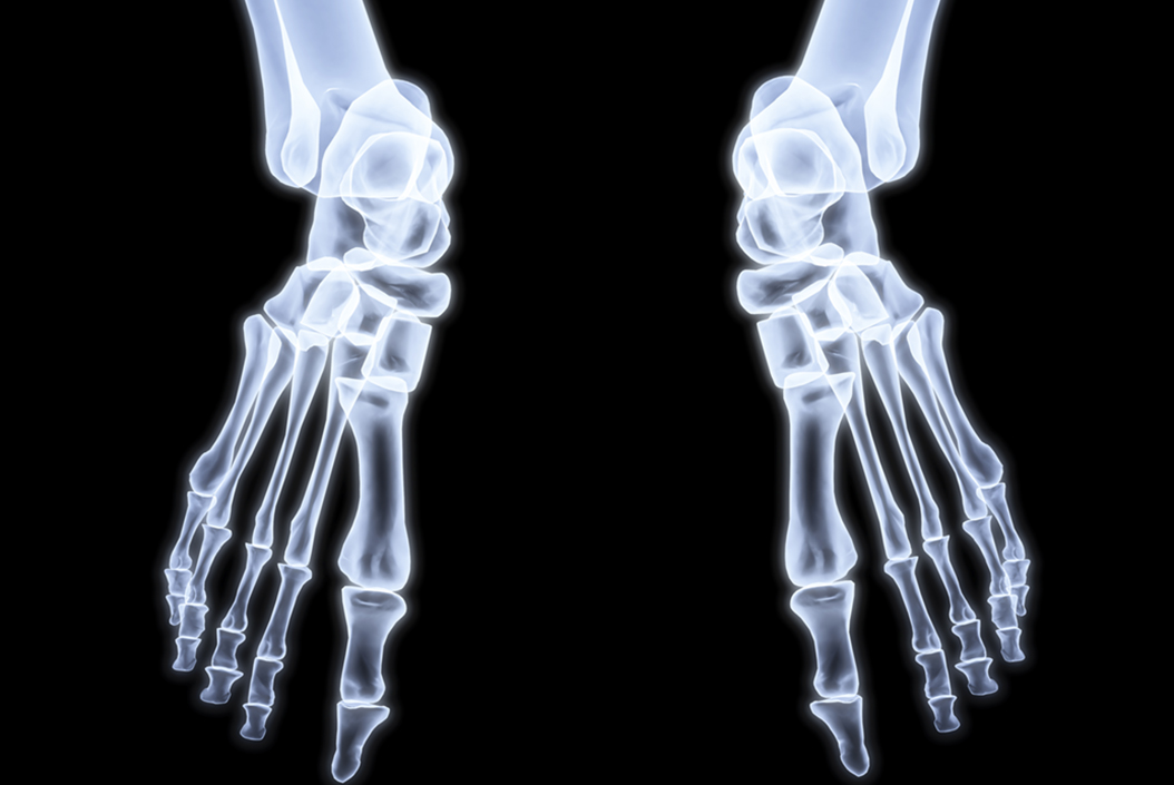 Morton's neuroma - human legs under X-rays. 3d image.