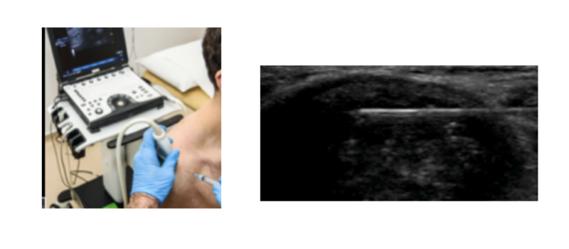 shoulder pain - two images side by side showing and ultrasound-guided injection of the shoulder being performed