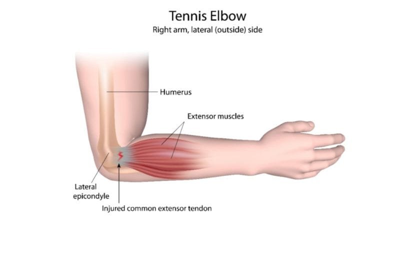 Tennis elbow - Graphic of the bone and ligament structure of the human elbow