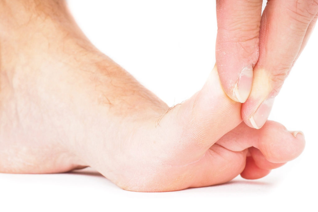 Osteoarthritis - Image of a bare foot with the big toe being held up by fingers