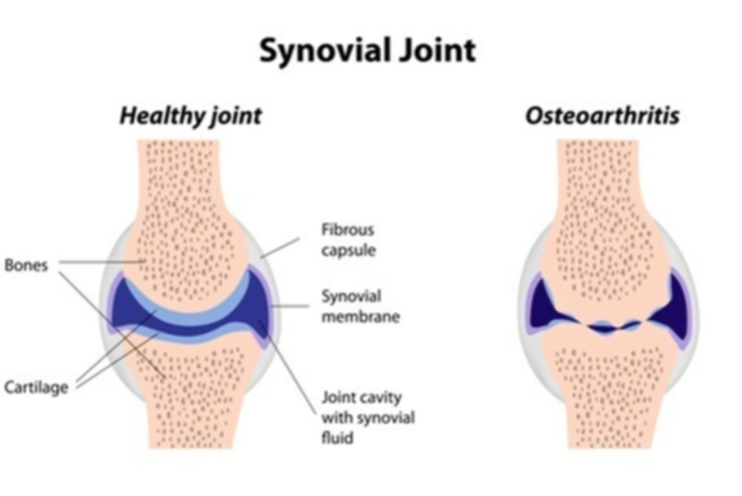 Osteoarthritis - Synovial joint graphic cross section