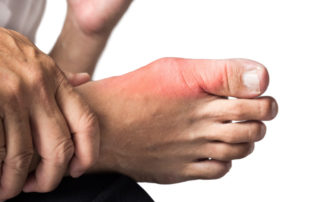 Osteoarthritis - Image of a bare foot with the big toe area highlighted in red.