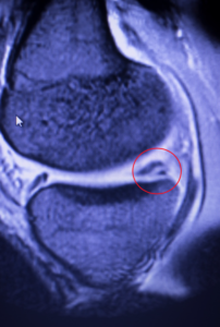 MRI scan image showing a meniscal tear