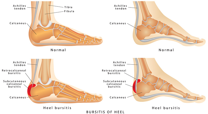 tratamentul condromului de șold dureri la nivelul genunchiului și gambei