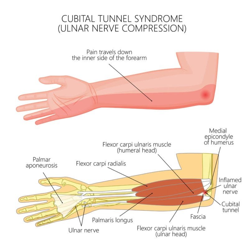 Cubital tunnel syndrome