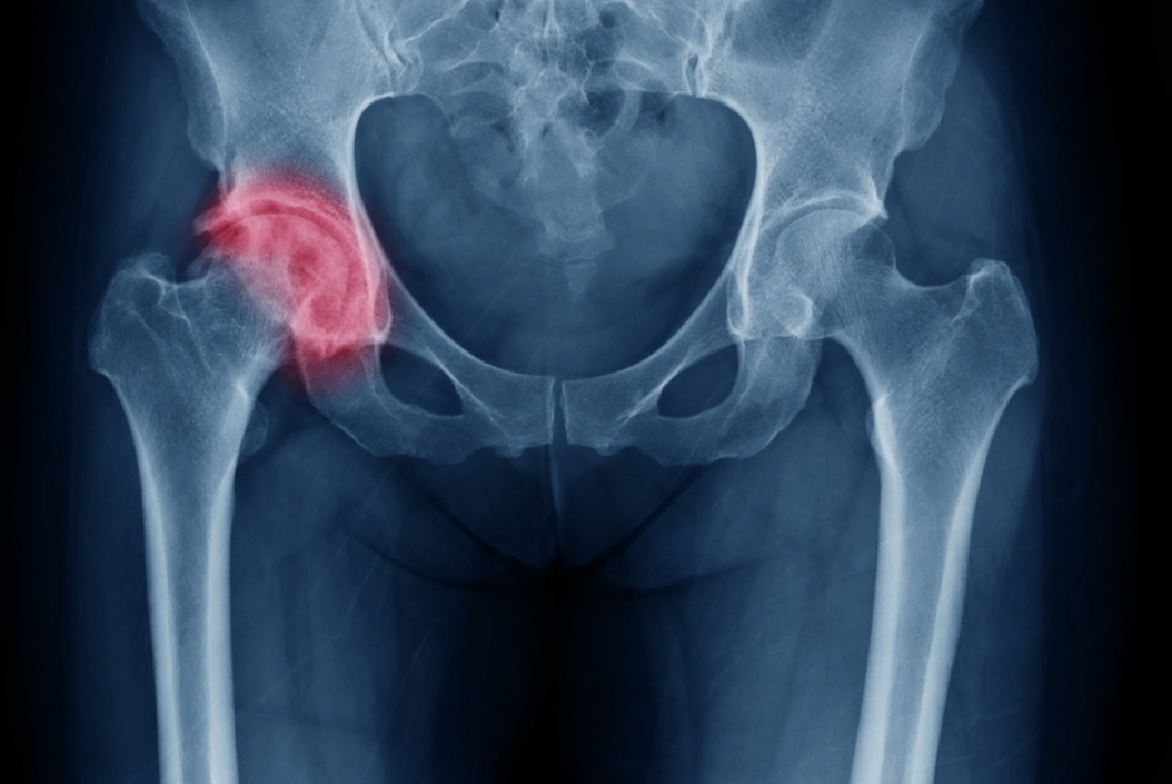 Hip osteoarthritis