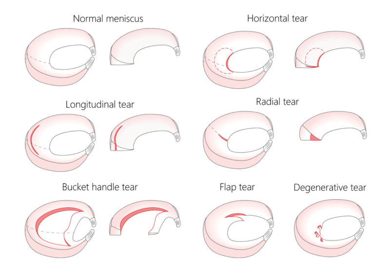 diagrams of meniscus cartilage showing different types of meniscal tears