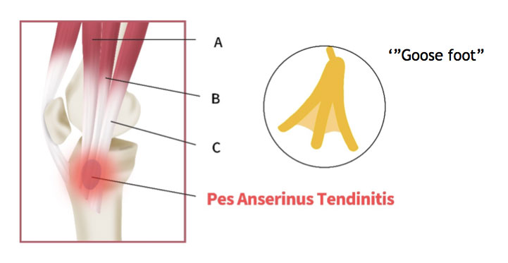 diagram showing the 3 tendons that concern the pes anserine bursa, describing them as a 'goose foot' formation