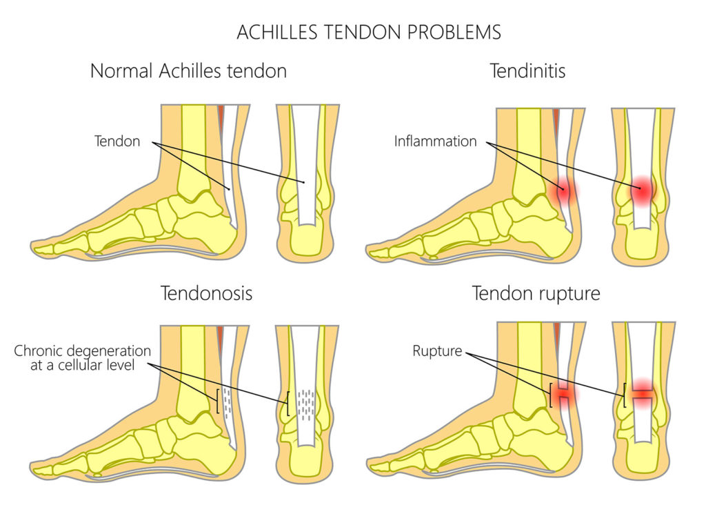 Return of strength after Achilles tendon surgery