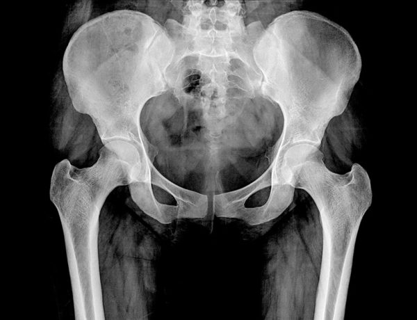 iliopsoas tendinopathy - X-ray image of human hips