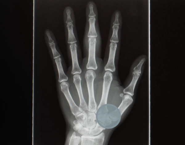 first cmc - an x-ray image of a hand.