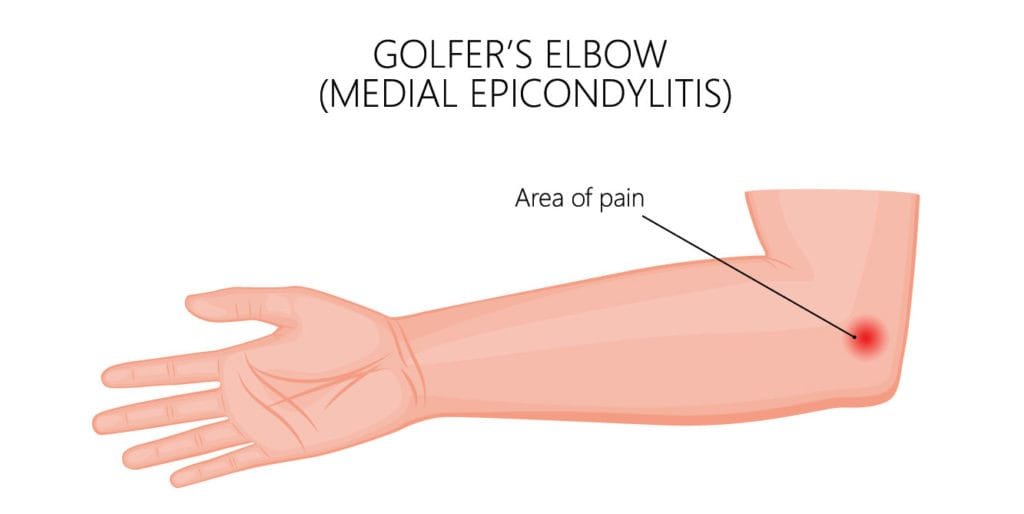 golfer's elbow