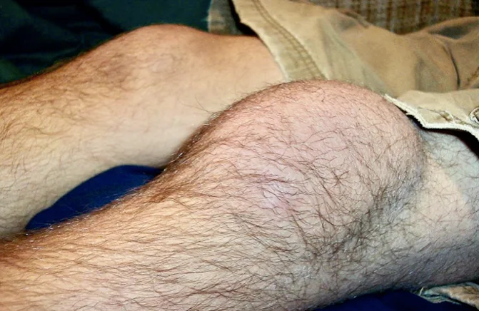 Prepatellar bursitis (known as Housemaid’s Knee)