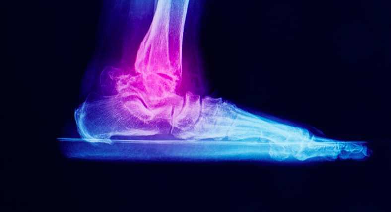 ankle joint x-ray