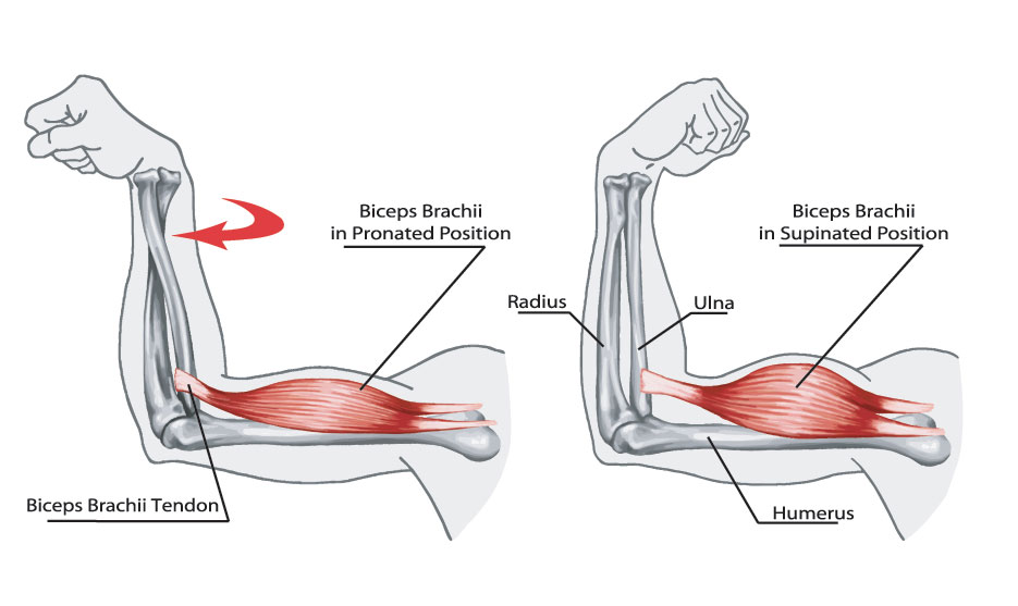 Distal biceps tendon - Graphic depiction of Biceps Brachii in Pronated and Supinated positions