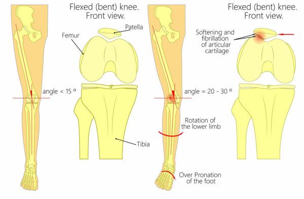 diagram showing anatomy of knee joint suffering from patellofemoral pain