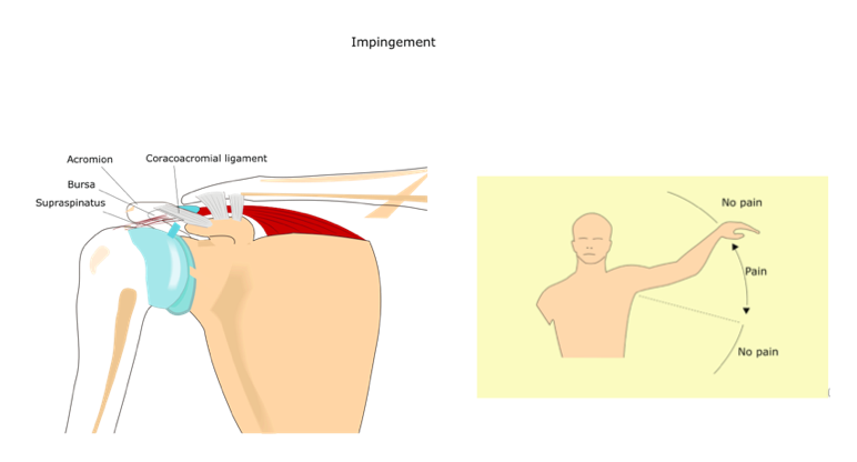 shoulder impingement diagnosis