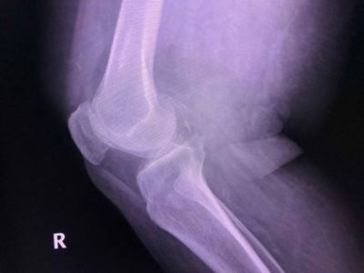 x-ray image of knee joint with patellofemoral kneecap pain