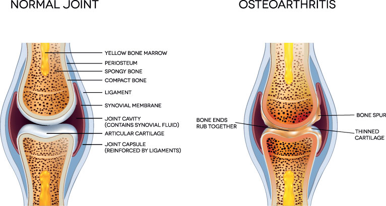 first cmc - graphic of a normal and an osteoarthritic joint.