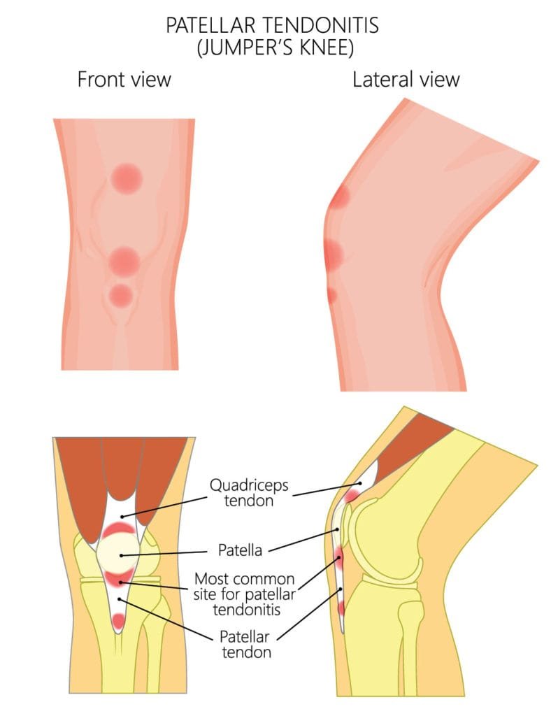 patella tendinopathy - patellar tendonitis jumpers knee shown from front view and side view