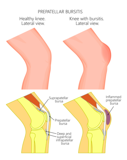 knee bursitis csípőízületi gyulladás okoz betegséget