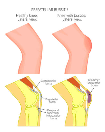 torn bursa sac knee