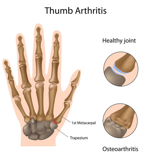 first cmc - Graphic of arthritis of the thumb