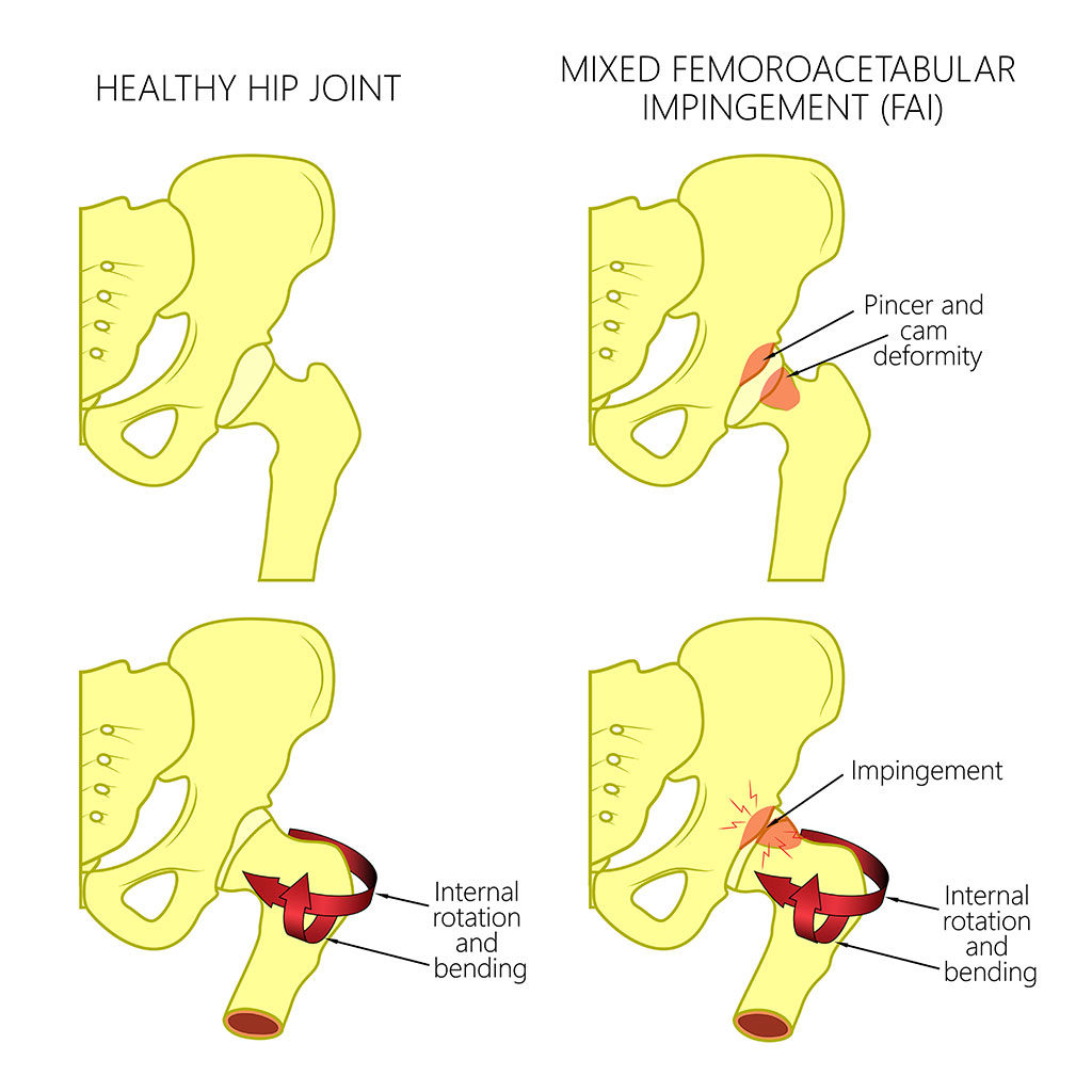 femoral acetabular impingement