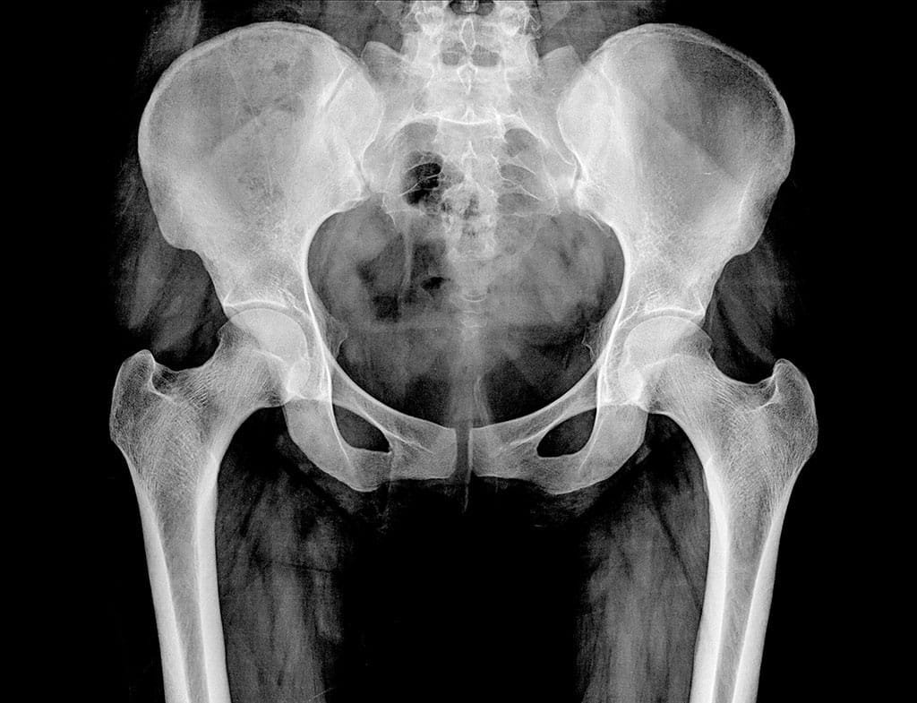 femoral acetabular impingement