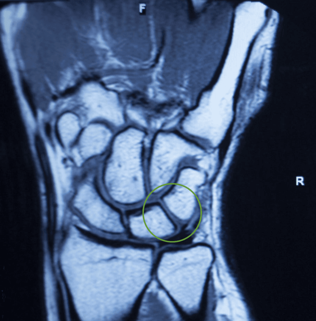 scapholunate ligament injury