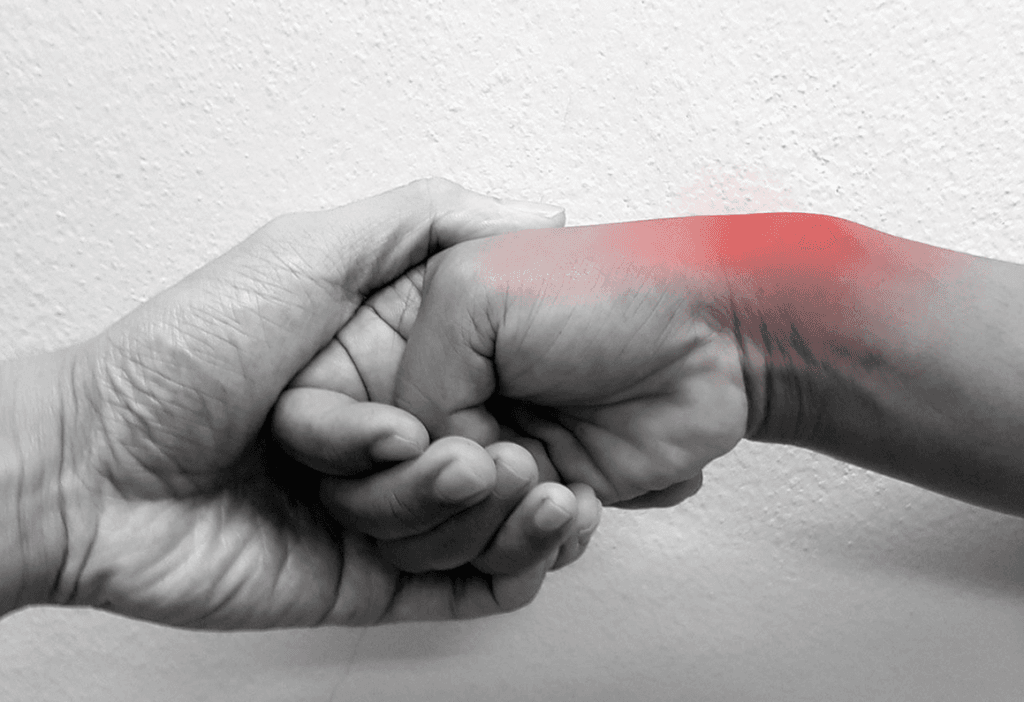 DeQuervain’s tenosynovitis