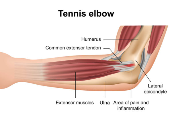 Tennis_elbow_ultrasound-guided_injection-fenestration_pain
