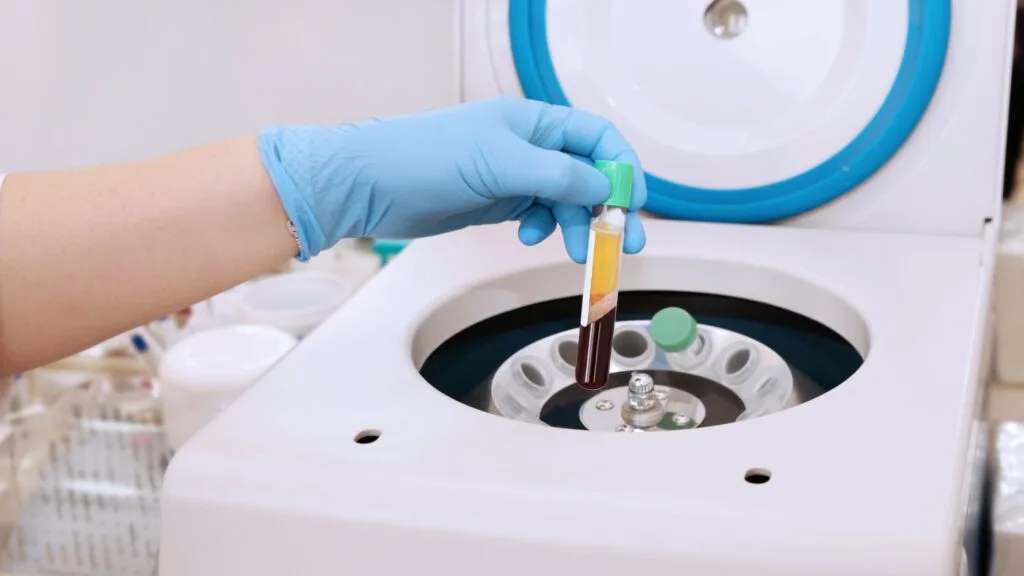 Are Platelet Rich Plasma (PRP) injections effective for treating rotator cuff tears of the shoulder?