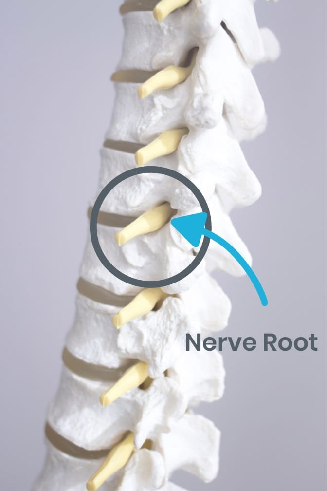 nerve-root