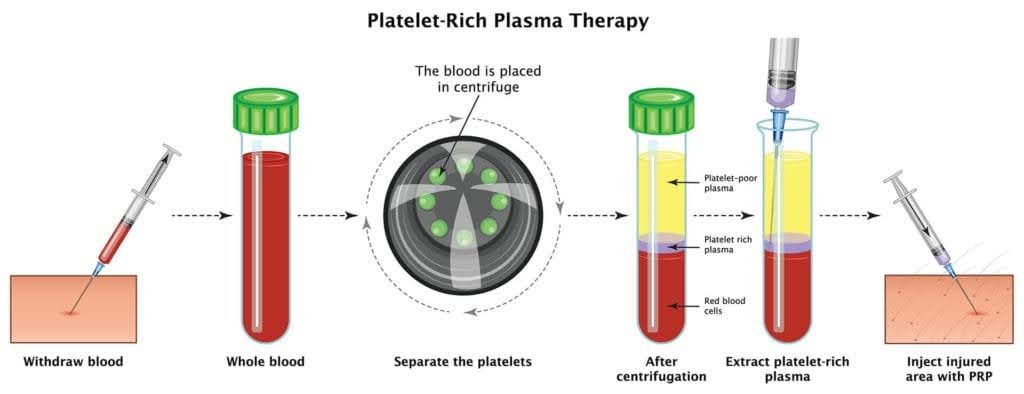 platelet-rich-plasma-therapy